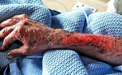 an burnt forearm resting on a blue blanket