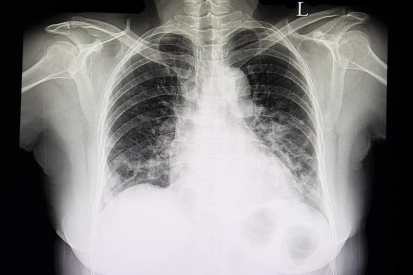 A chest xray film of patient with heart failure