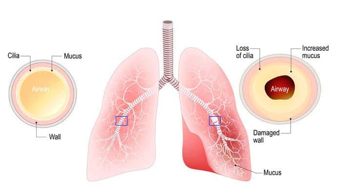 cilia bronchitis lungs