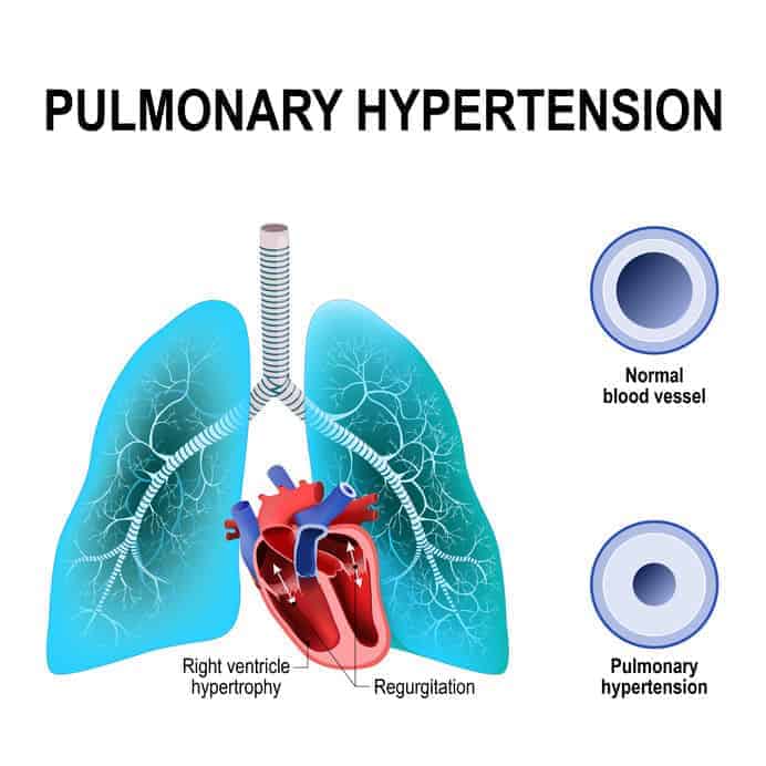 pulmonary hypertension graphic