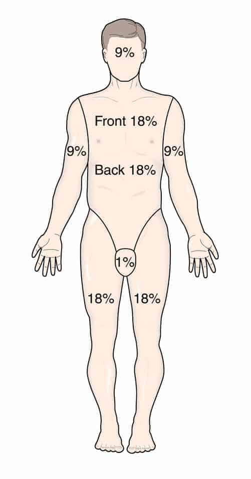 diagram showing rule on nines burn formula on male body