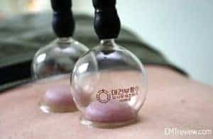 Cupping-DL085130t