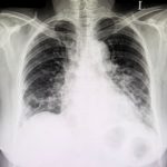 A chest xray film of patient with heart failure