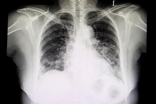 A chest xray film of patient with heart failure