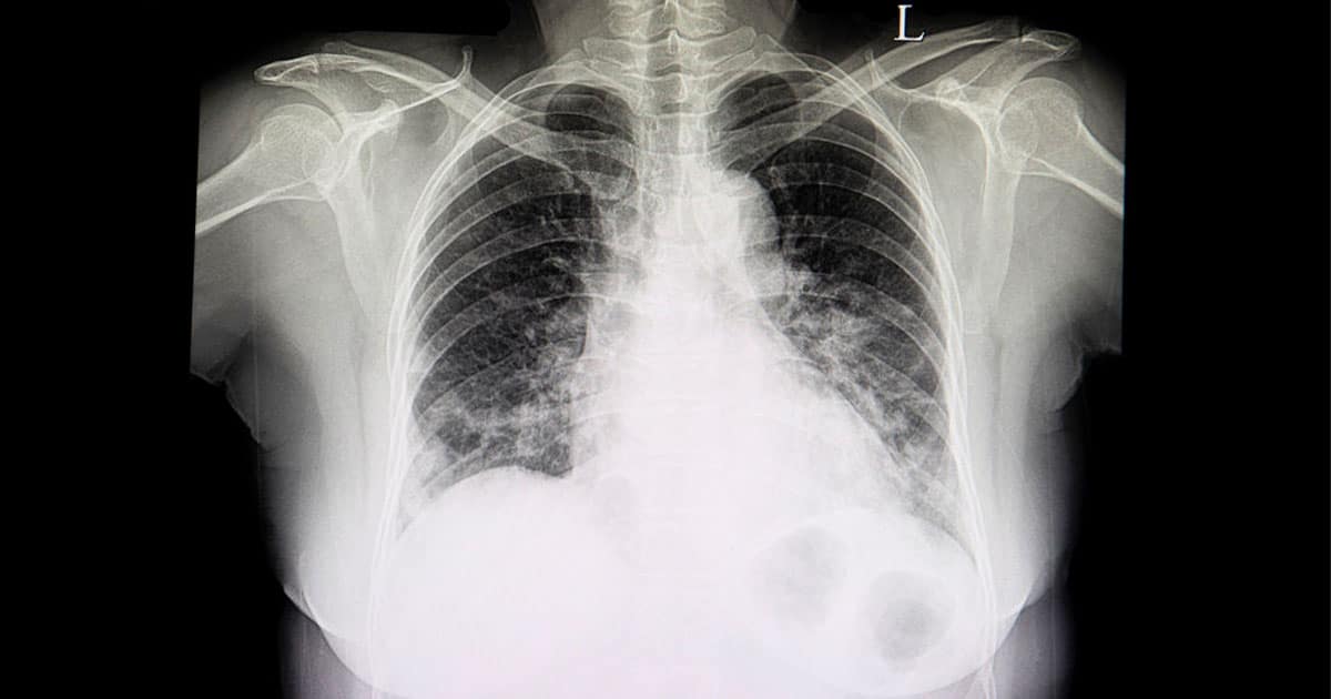 Mucus In Lungs X Ray