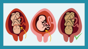 graphic showing three babies inside womb: one with nuchal cord, one breech, one cephalic