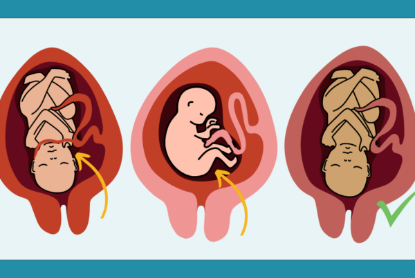 graphic showing three babies inside womb: one with nuchal cord, one breech, one cephalic